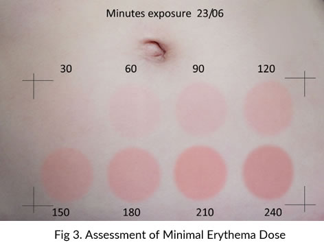 Assessment of Minimal Erythema Dose