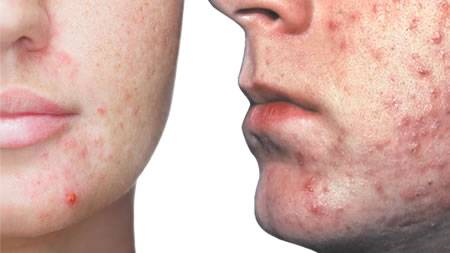 Acne skin course